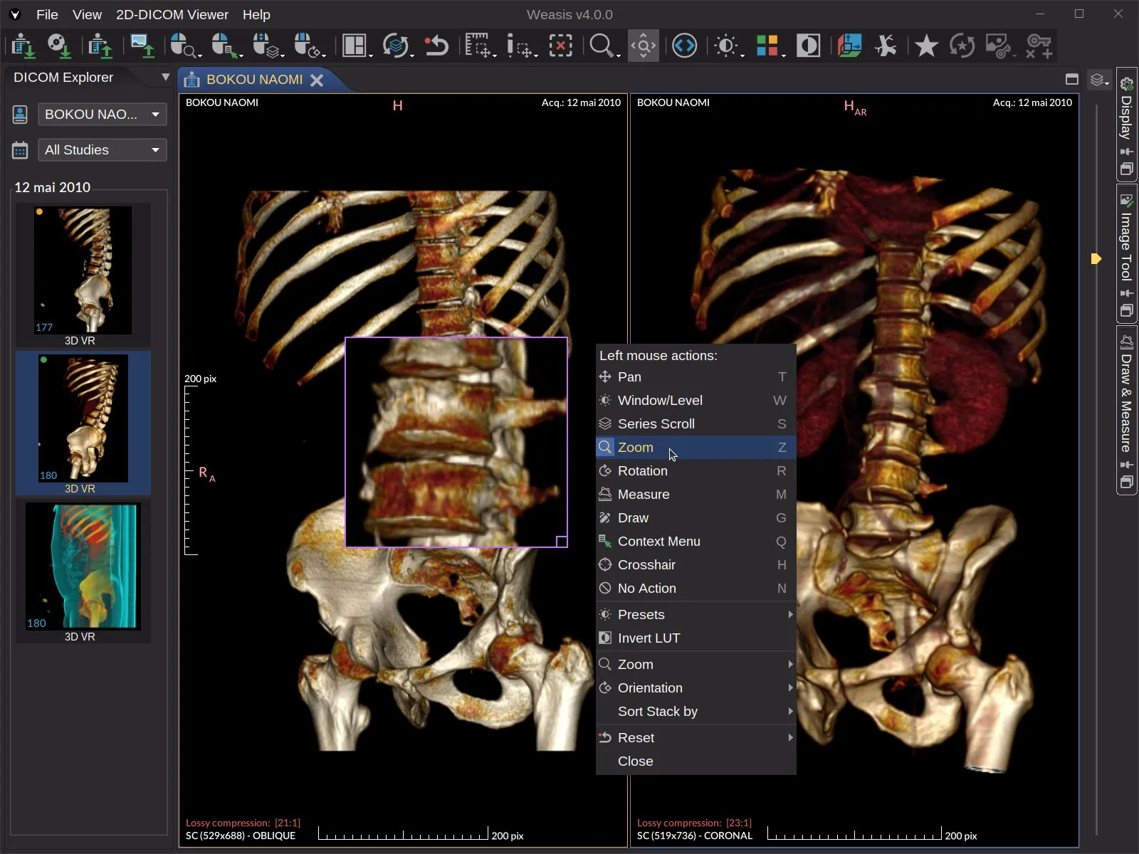Weasis DICOM medical viewer screenshot 1